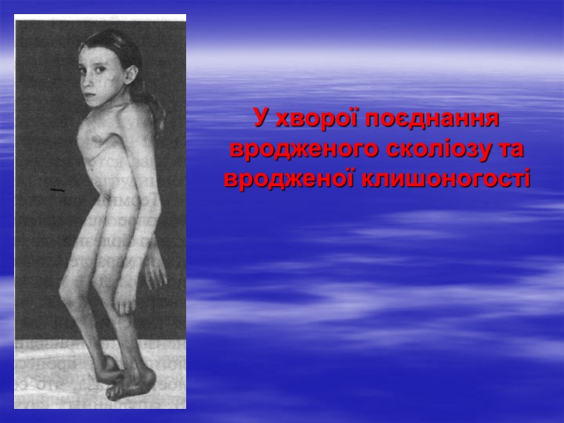 У хворої поєднання вродженого сколіозу та вродженої клишоногості